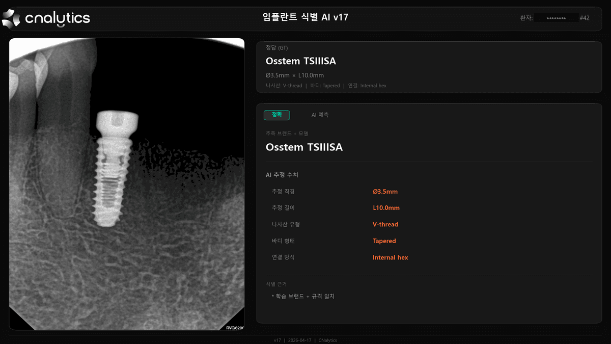 임플란트 X-ray 판독